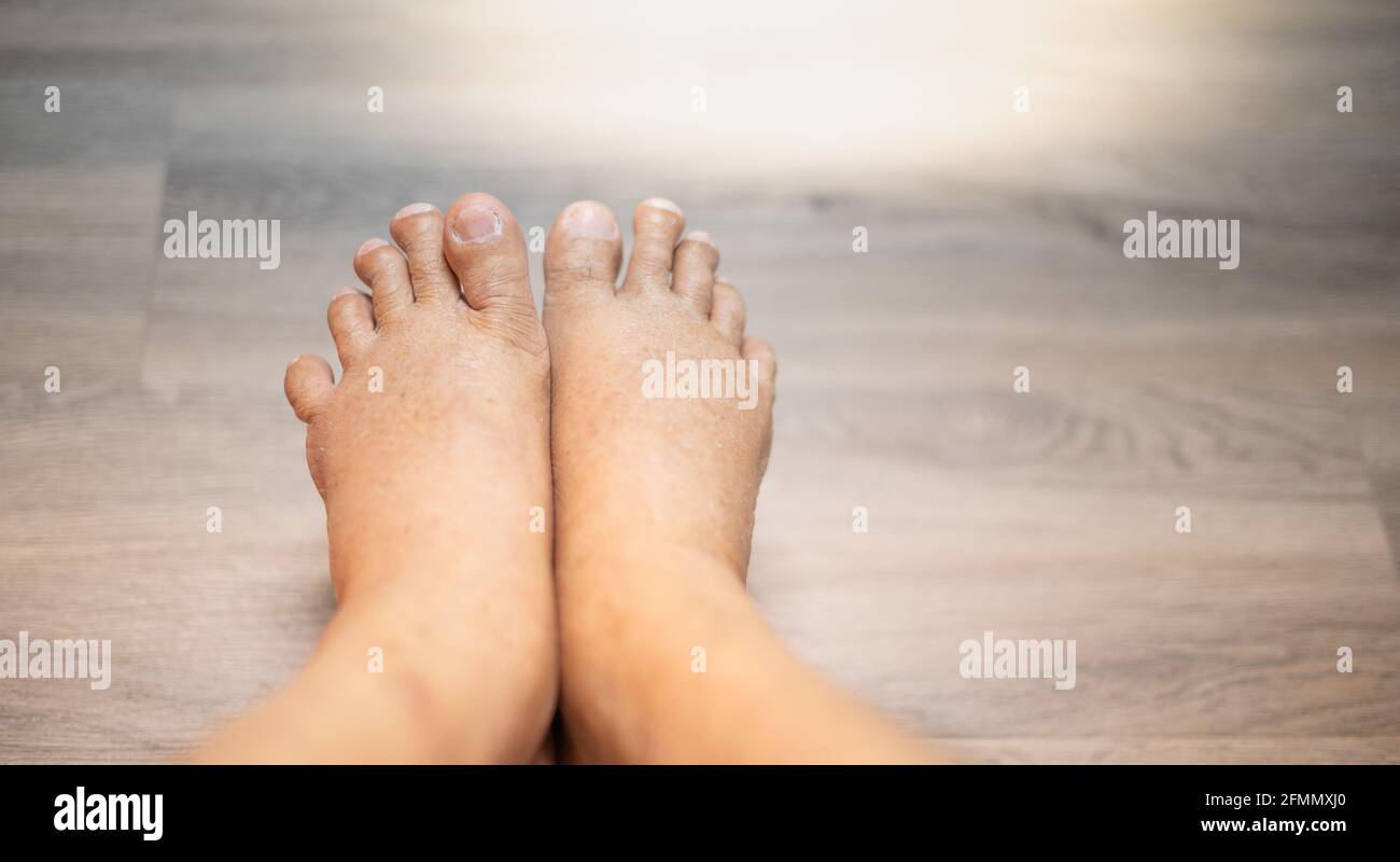 The feet of old man wrinkle skin swollen feet with the cancer and the body lack of the protein