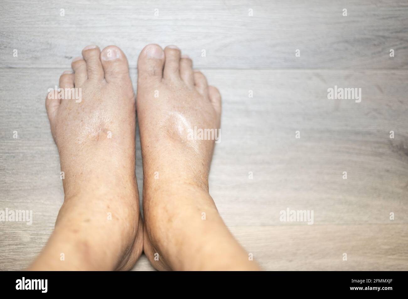 The feet of old man wrinkle skin swollen feet with the cancer and the body lack of the protein