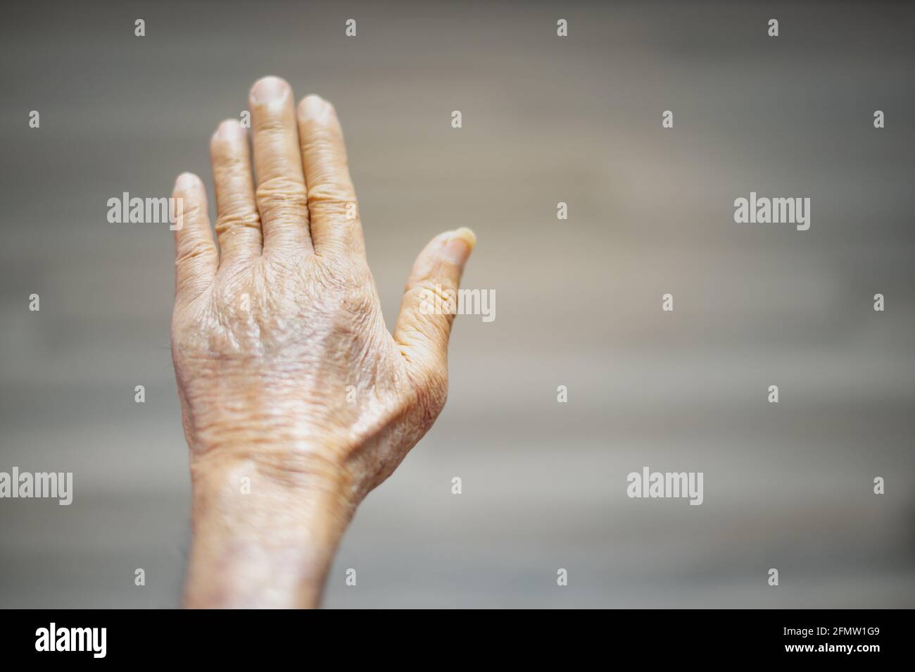 Bruised hands hires stock photography and images Alamy