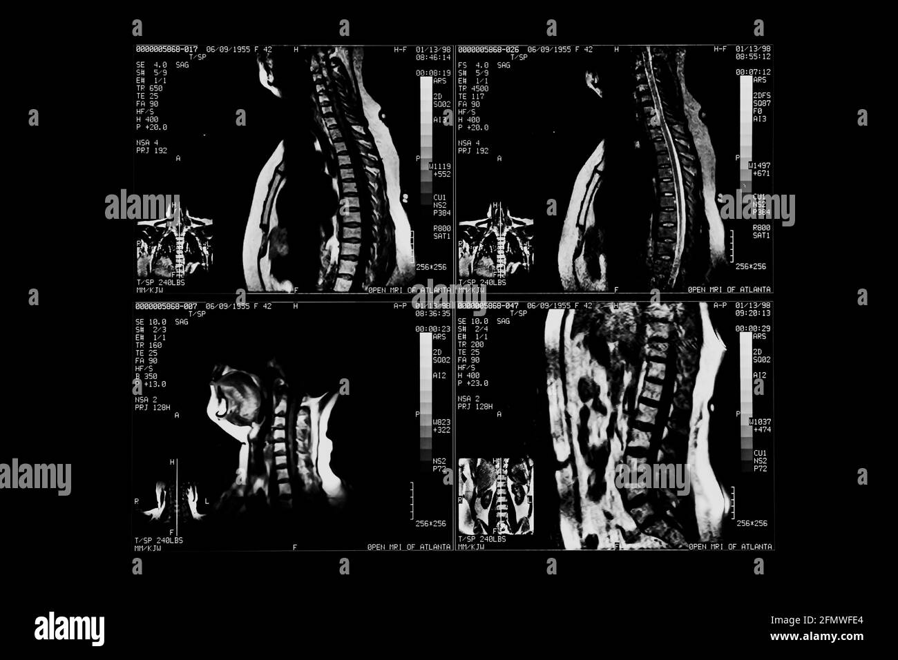 Computer tomography image of human body. Black and white x-ray film Stock Photo