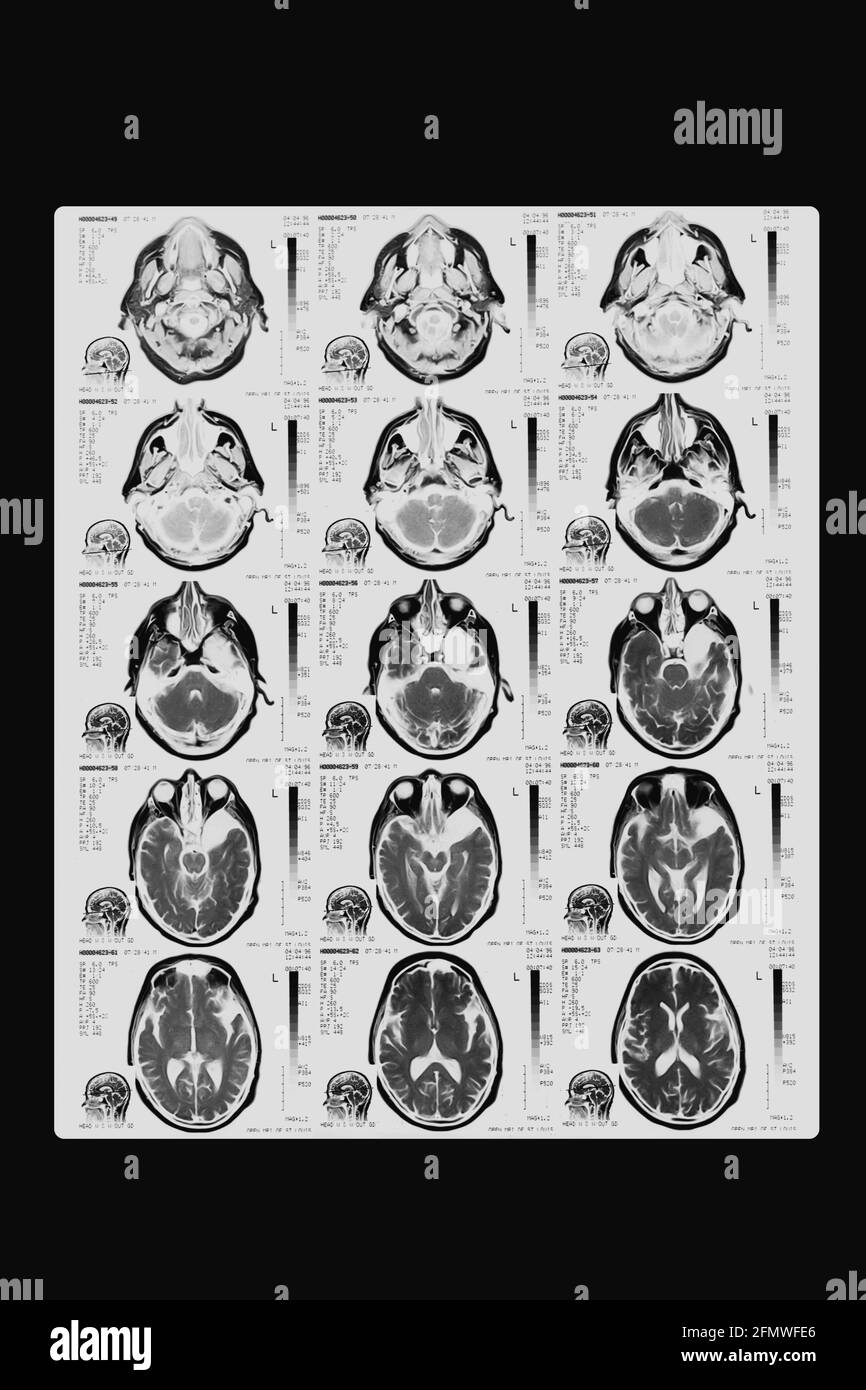 Computer tomography image of human brain regions. Black and white x-ray film Stock Photo