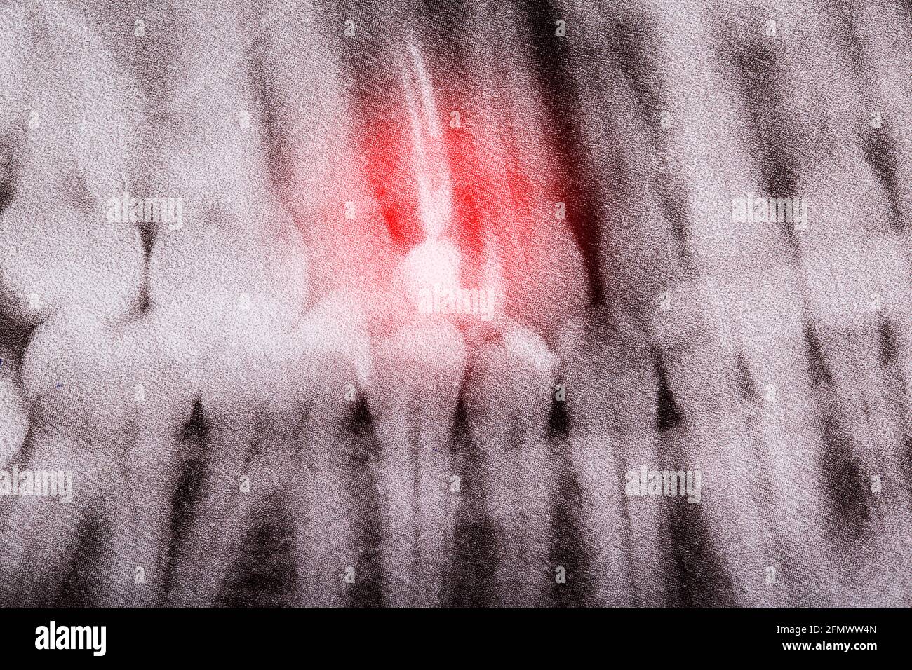 Tooth pulpitis on a dental x-ray, macro. Inflammation of the root canals and nerves. Chronic periodontitis Stock Photo