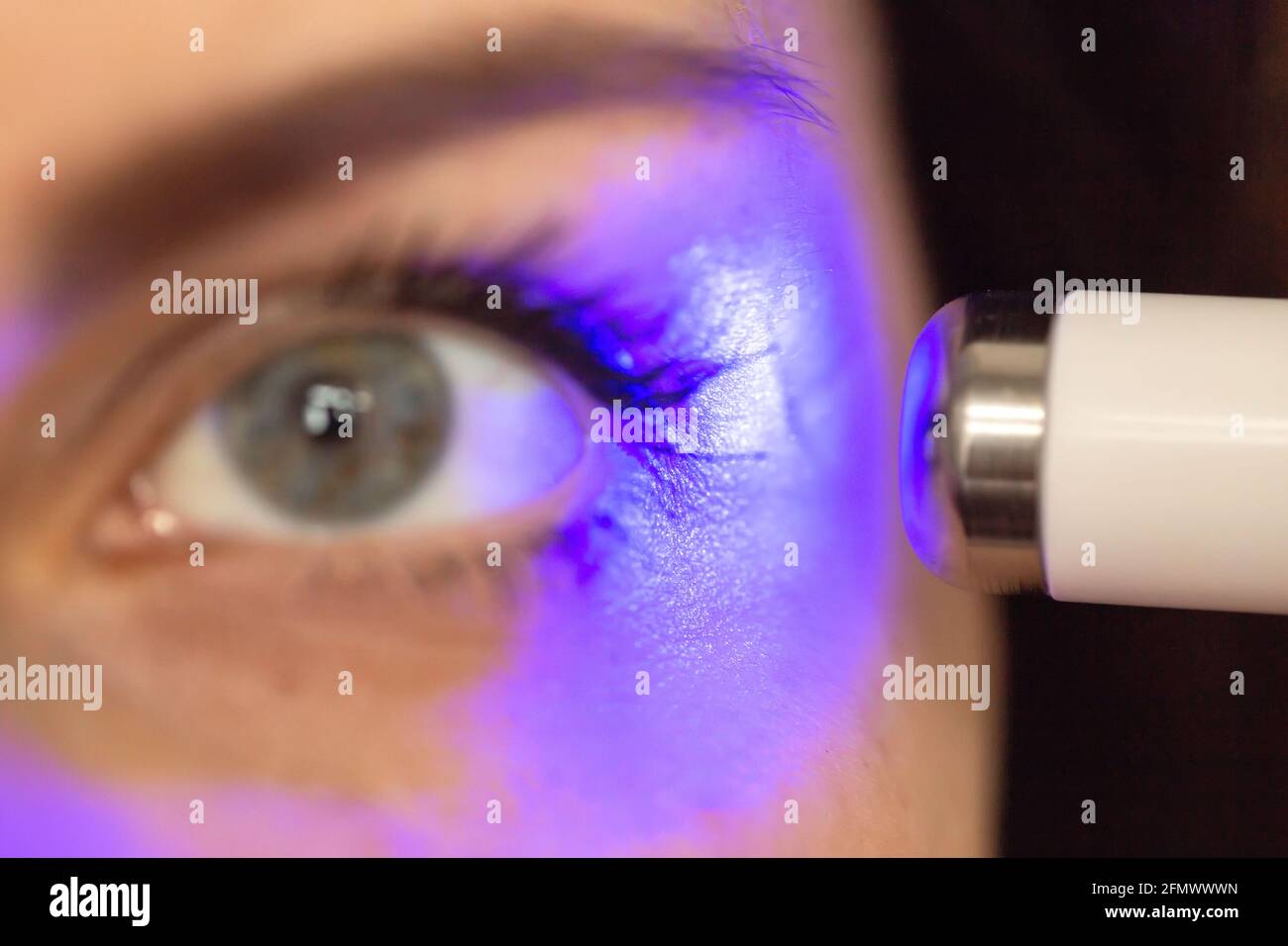 Professional removal of skin scars using laser resurfacing. The girl