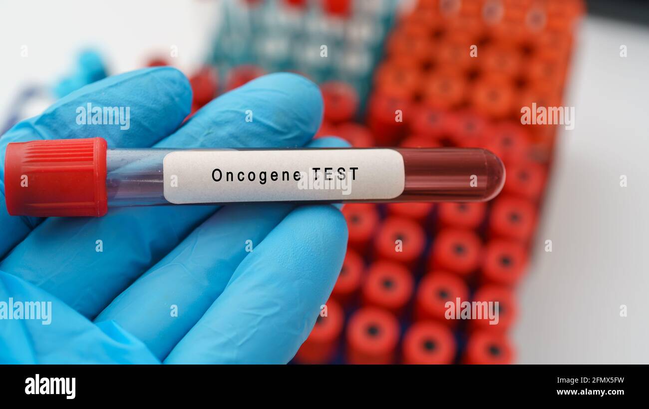 Oncogene test, cancer cell detection test result with blood sample in test tube on doctor hand in medical lab Stock Photo