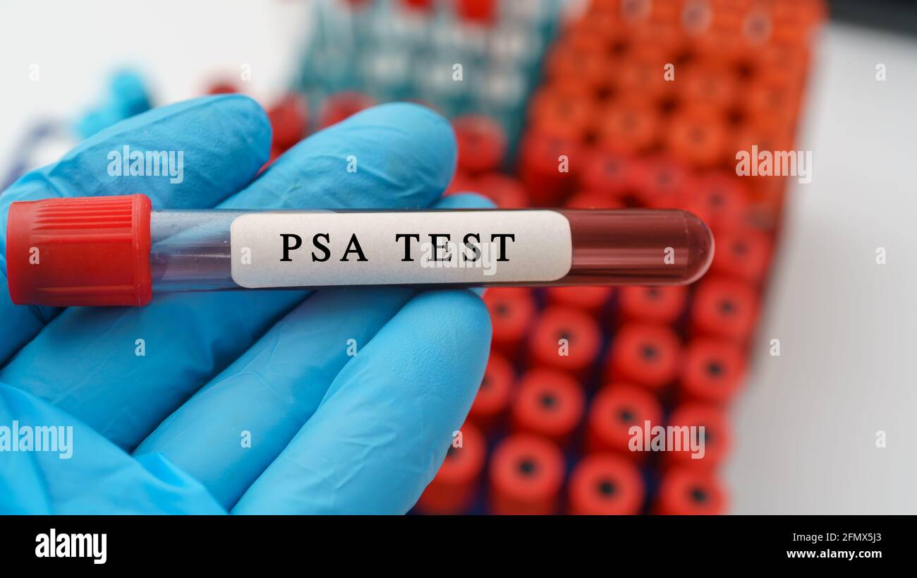 PSA test result with blood sample in test tube in hand Stock Photo
