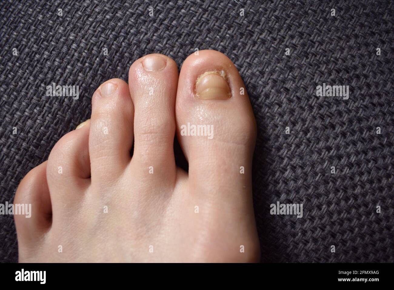 Growing nail on thumb after stepping from horse Stock Photo - Alamy