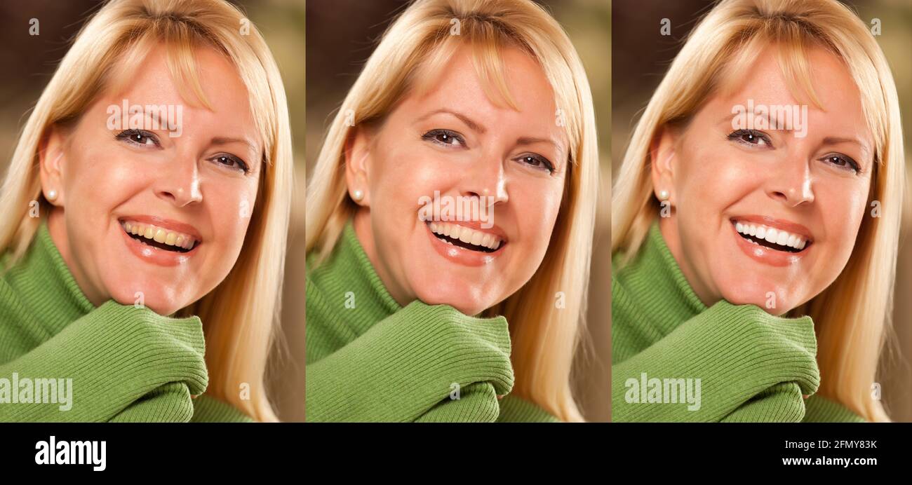 Smiling female showing progressive teeth whitening and bleaching. Stock Photo