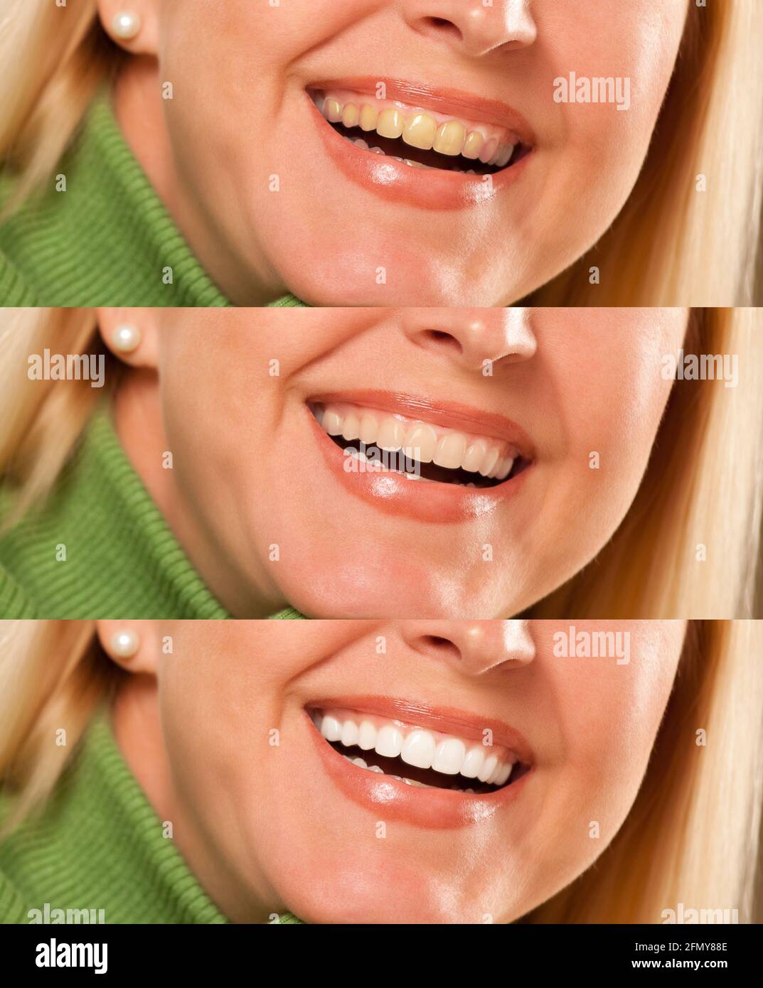 Smiling female showing progressive teeth whitening and bleaching. Stock Photo