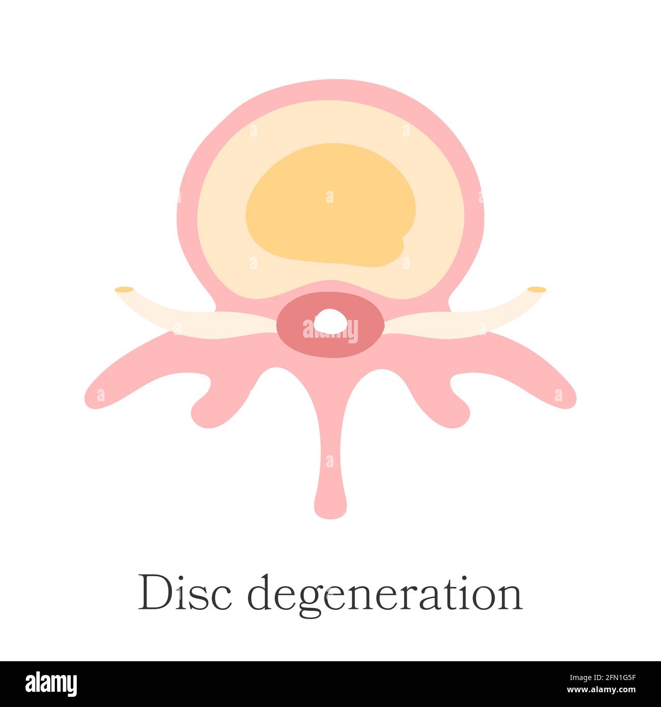 Herniated spinal - Degeneration disc. Vector diagram, hand drawn. Infographic of first stage hernia of intervertebral disk Stock Vector