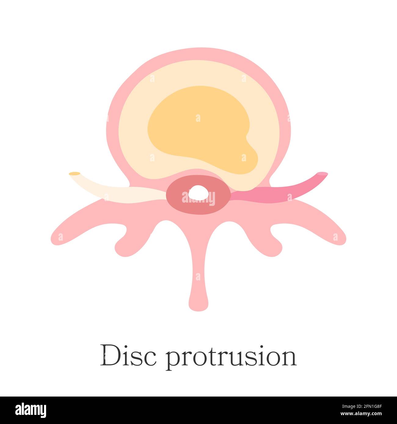 Herniated spinal - Protrusion Disc or Prolapse. Vector diagram, hand drawn. Infographic of second stage hernia of intervertebral disk Stock Vector