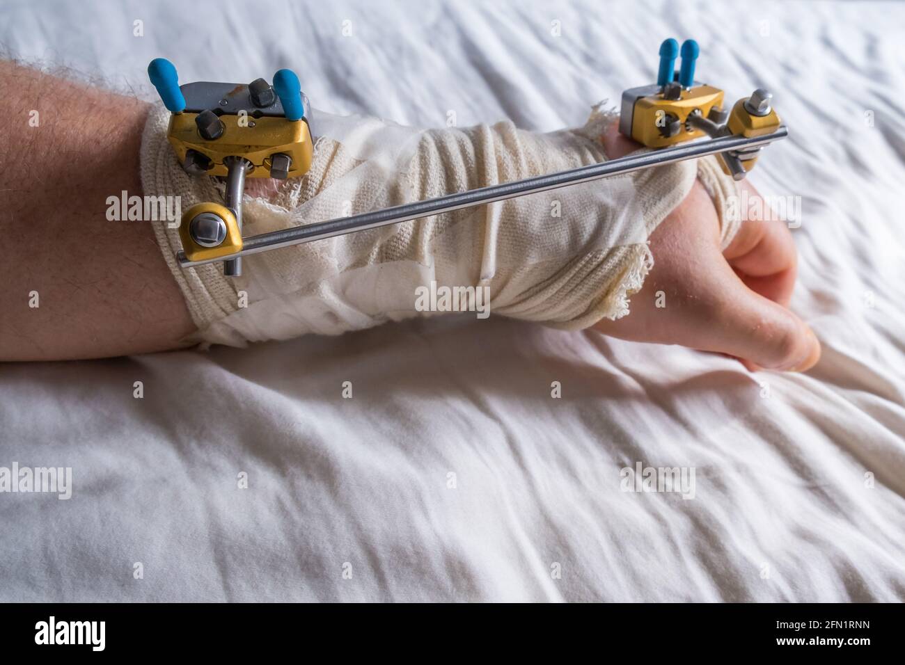 Metal fixture for a broken wrist Stock Photo Alamy
