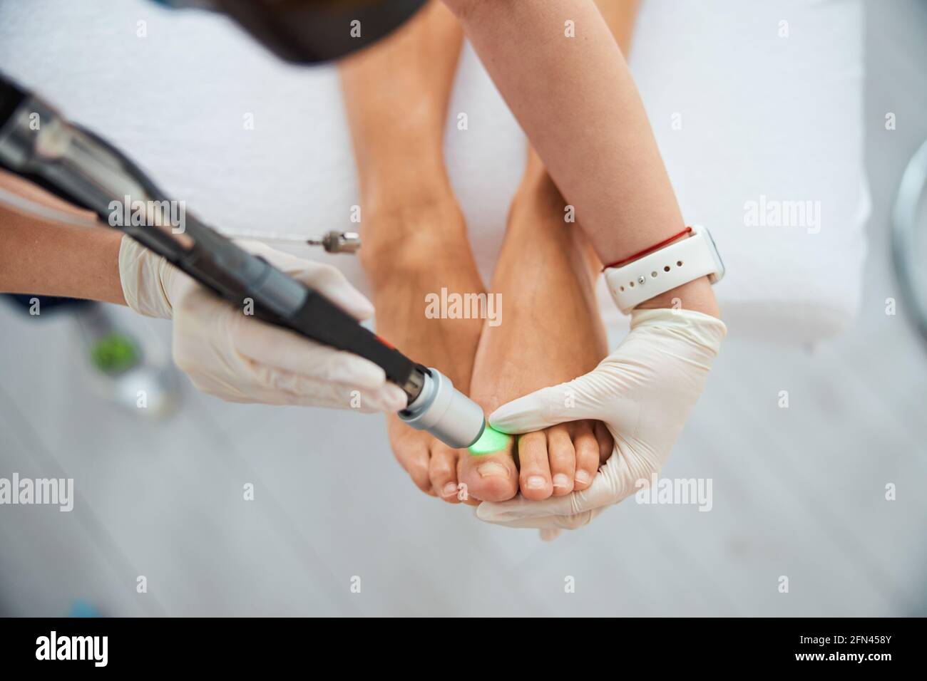 Patient undergoing a hair removal procedure on her toe Stock Photo