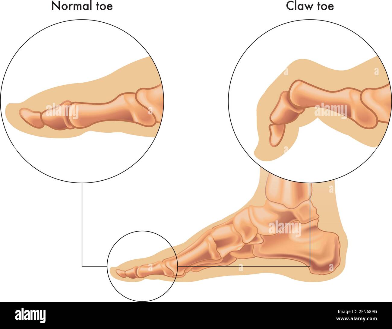 Medical illustration shows the difference between a normal toe and a claw toe, with annotations. Stock Vector