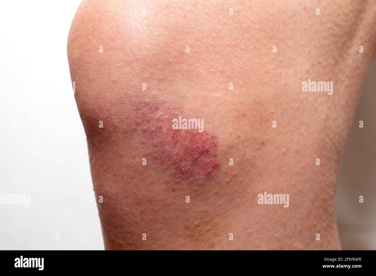Big red bruise on the knee. Injured knee joint. Hematoma Stock Photo