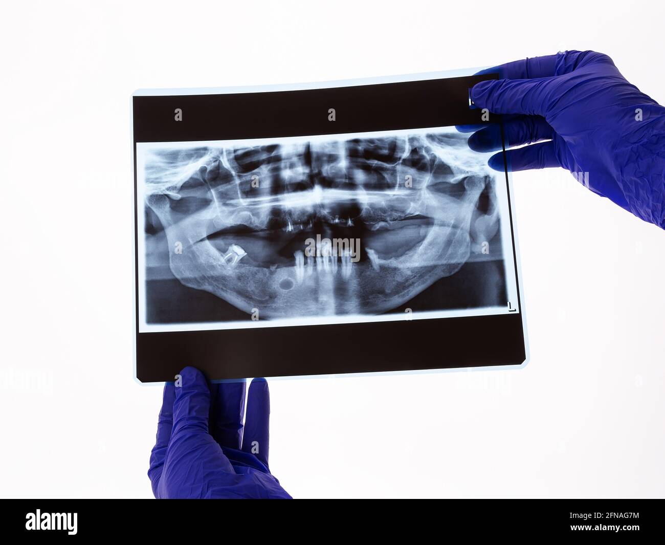 The dentist hands holding the panoramic facial x-ray image of an old person with some lower teeth and no tooth of the upper. Original x-ray teeth scan Stock Photo