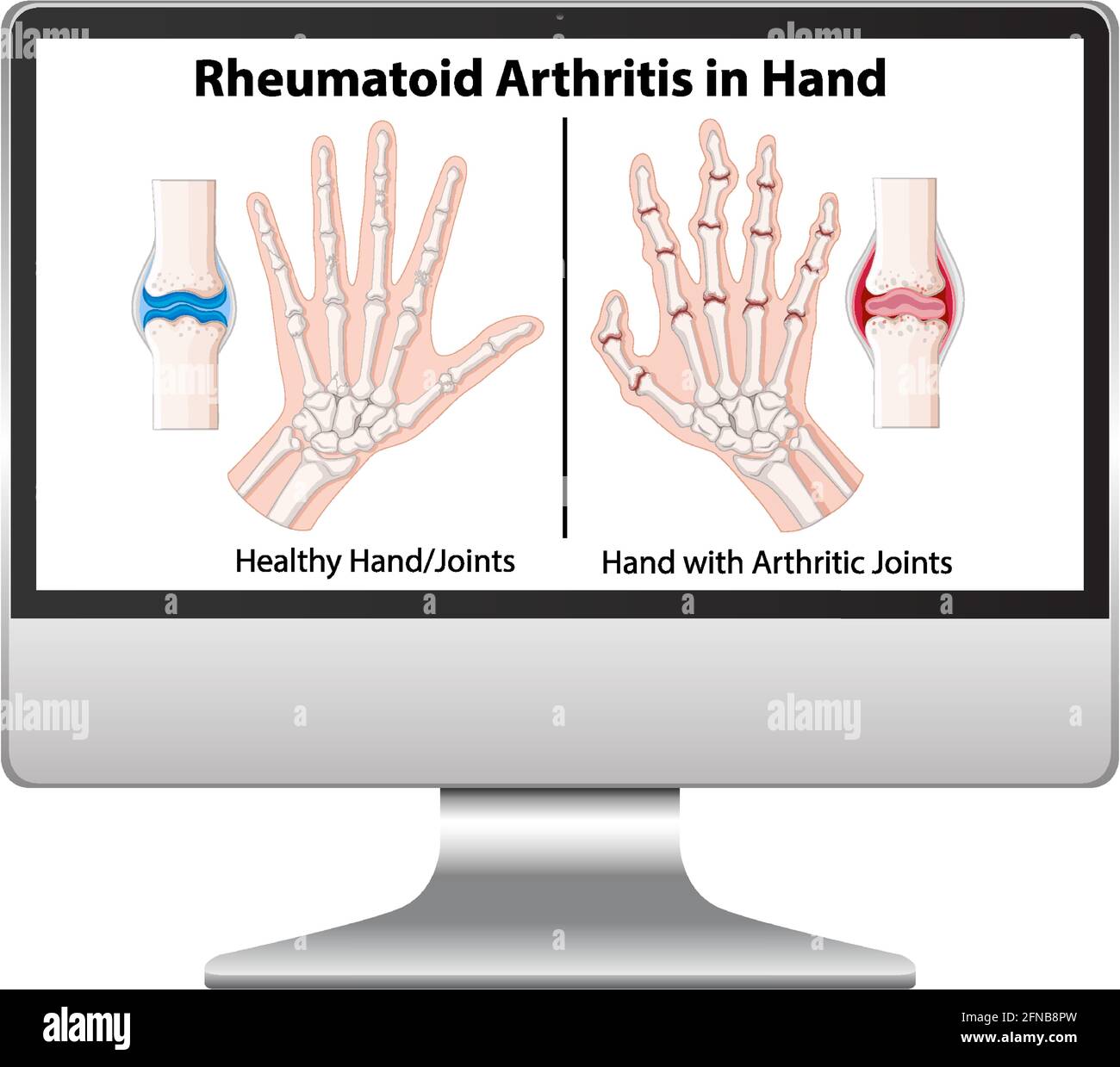 Rheumatoid arthritis symptoms on hand on computer desktop illustration