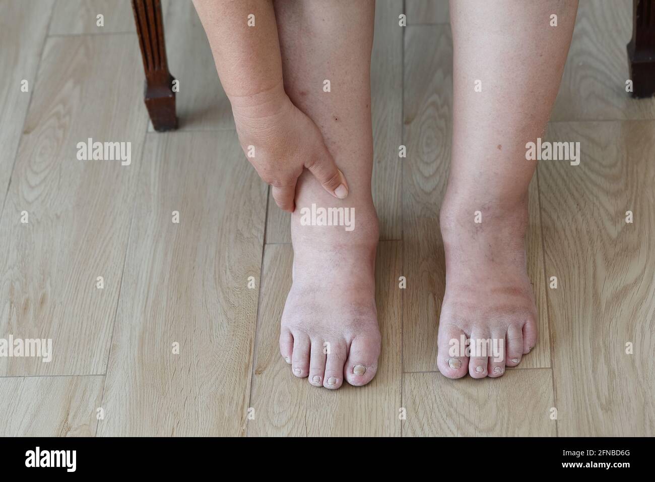 Black skin swollen hand hires stock photography and images Alamy