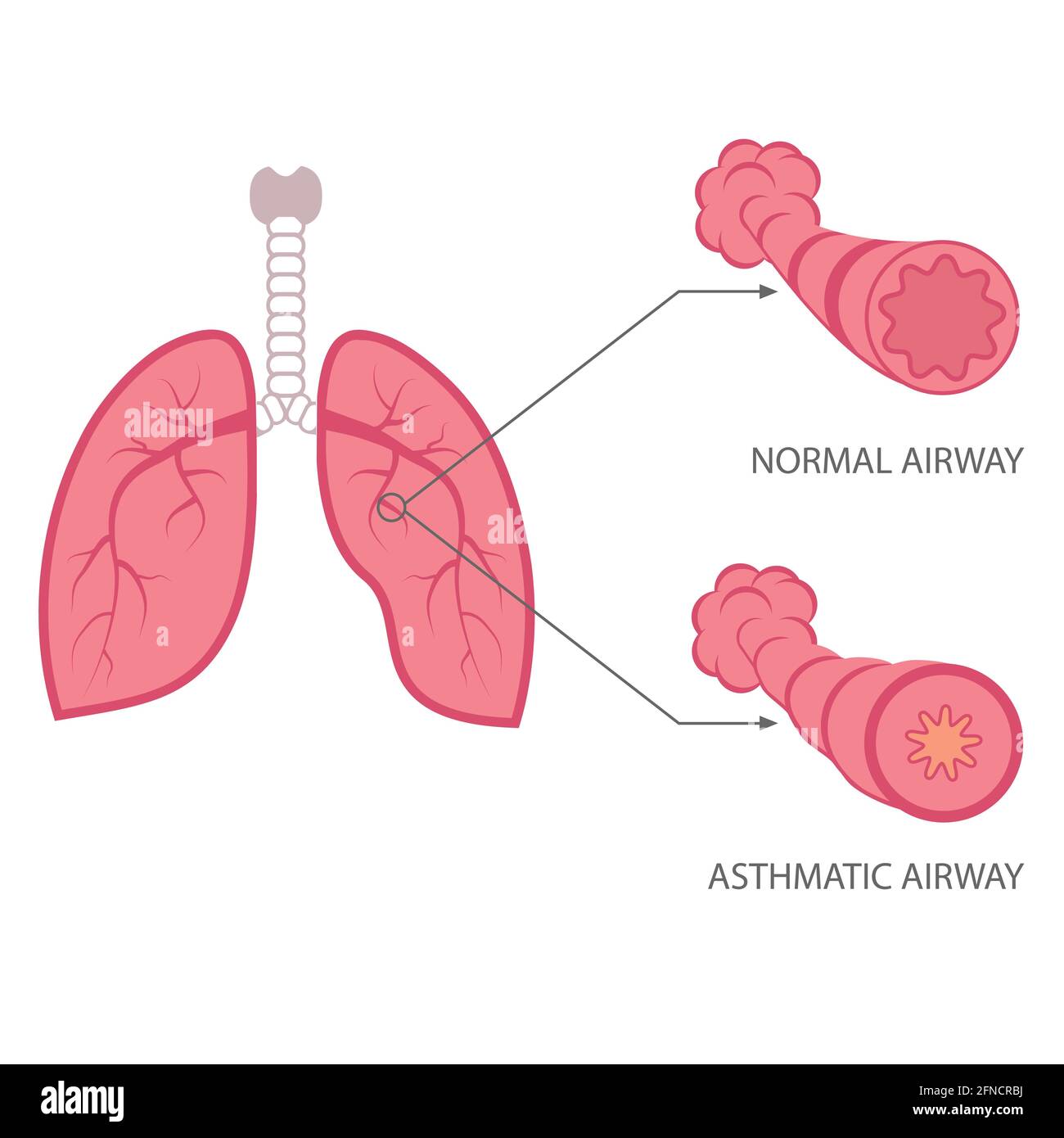 vector asthma illustration, bronchial, lungs respiratory disease Stock
