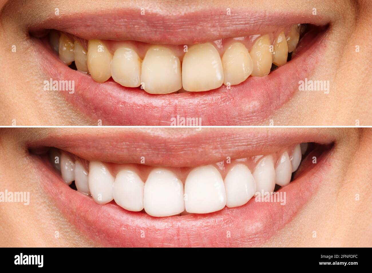 woman teeth before and after whitening. Over white background. Dental clinic patient. Image symbolizes oral care dentistry, stomatology. Stock Photo