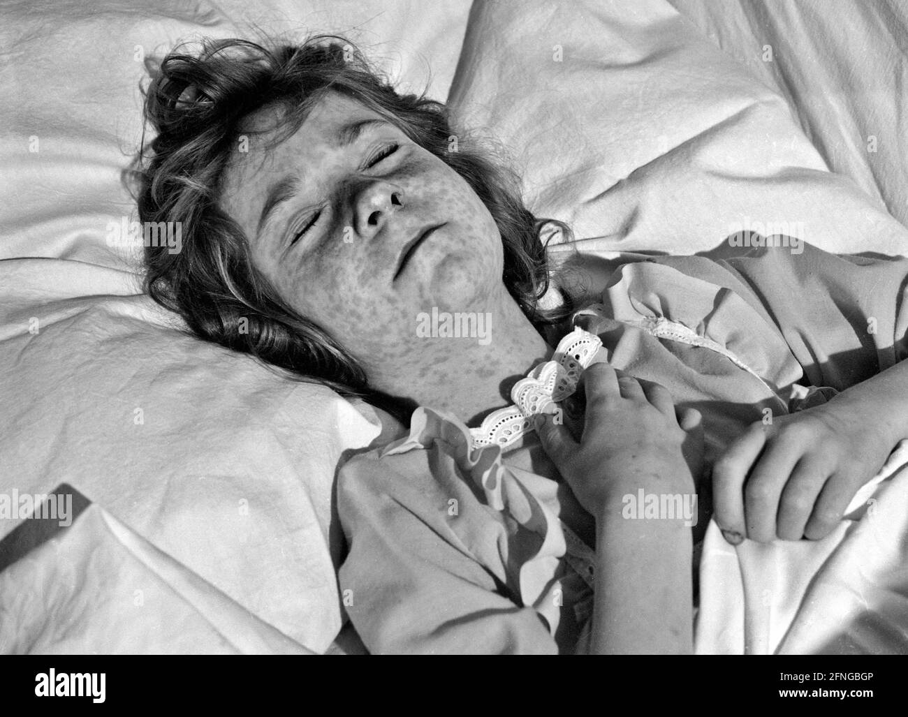 Five-year-old girl with severe measles infection [automated translation] Stock Photo