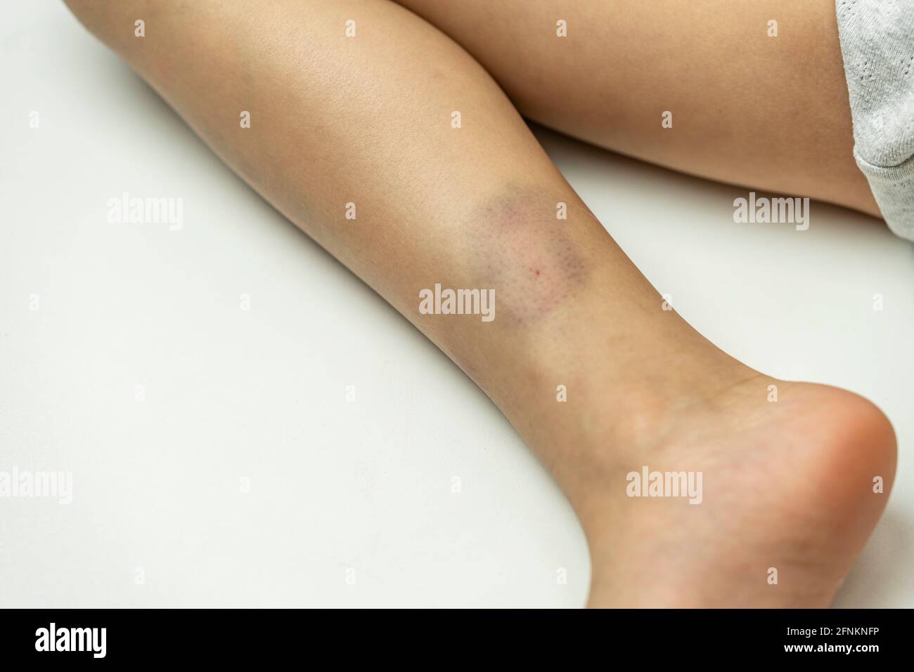 Close up Bruise on child leg Stock Photo Alamy