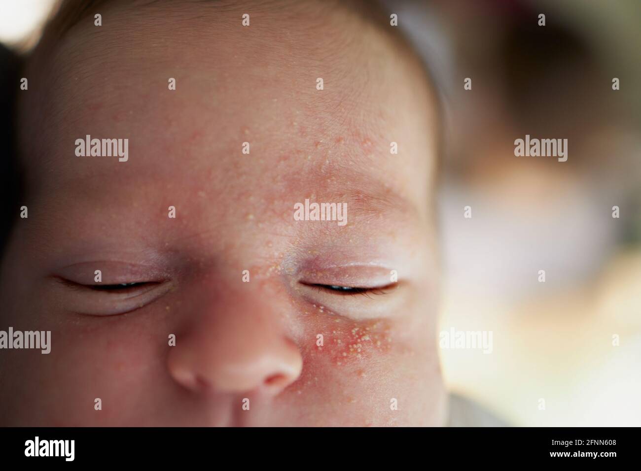 Neonatal acne on a baby face Stock Photo