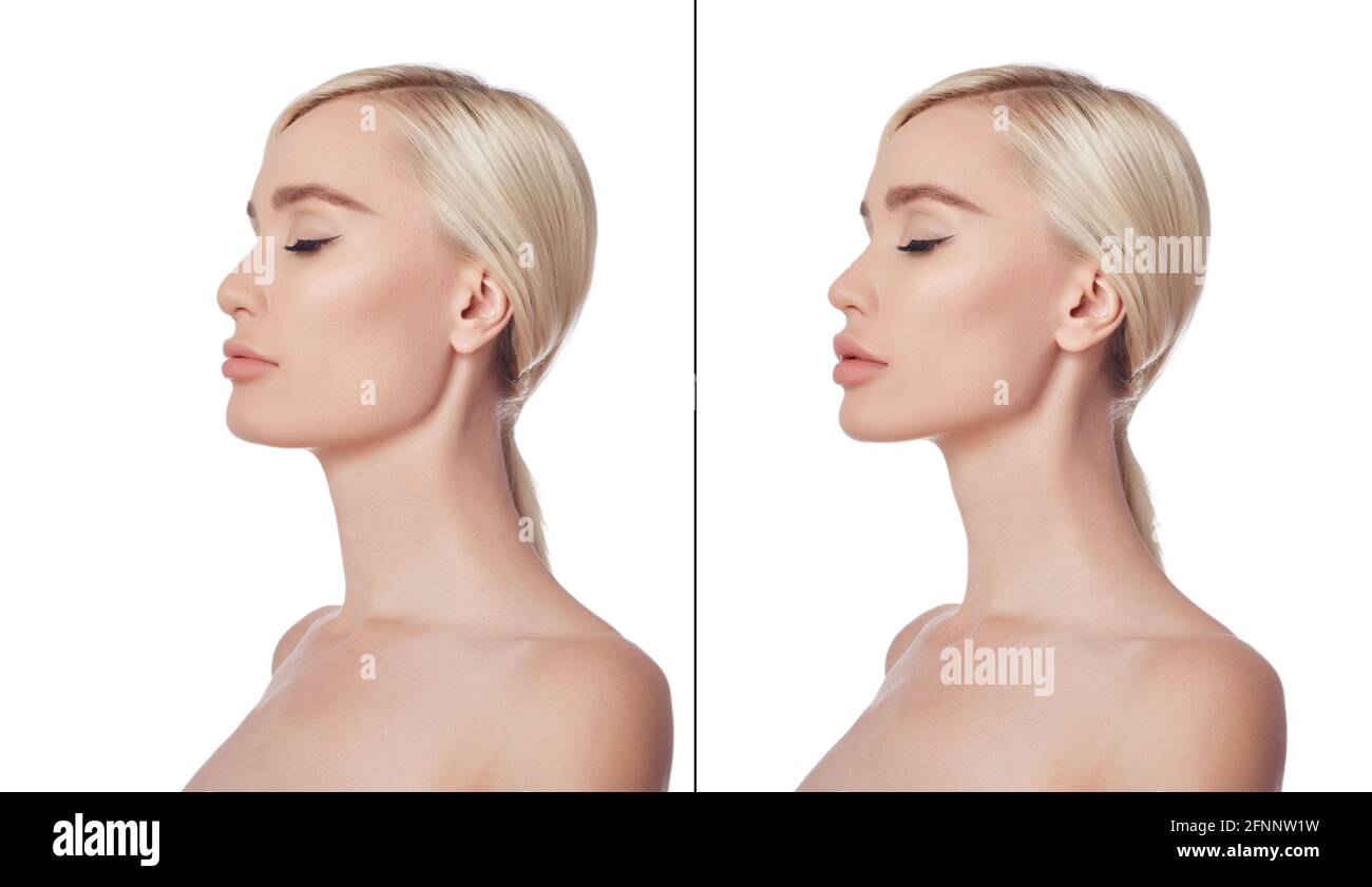 Before and after plastic chin surgery woman. Cosmetic chin correction,  plastic surgery, reduction surgery, nose reduction. Aesthetic medicine.  Portrai Stock Photo - Alamy