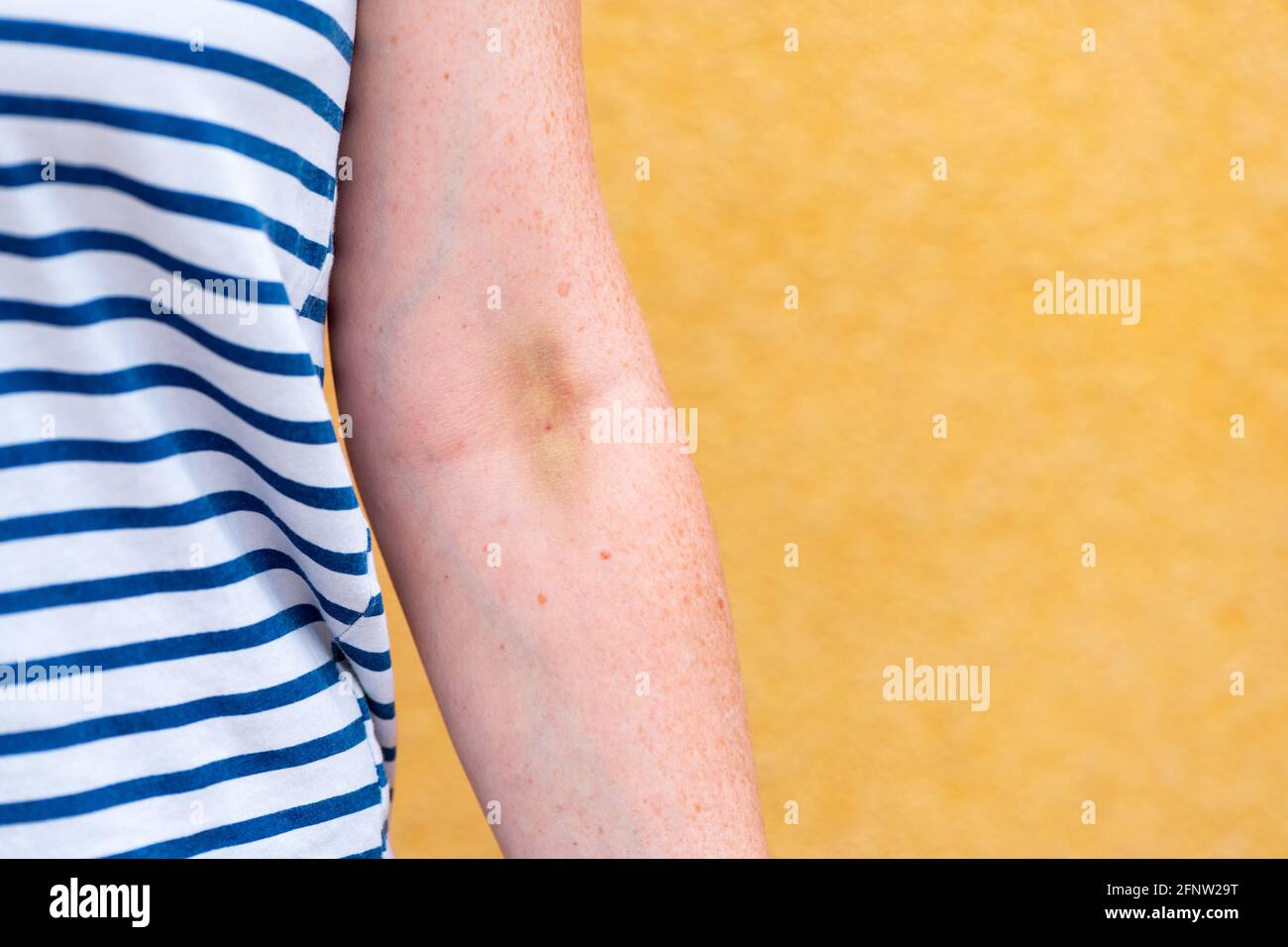 Hematoma hires stock photography and images Alamy