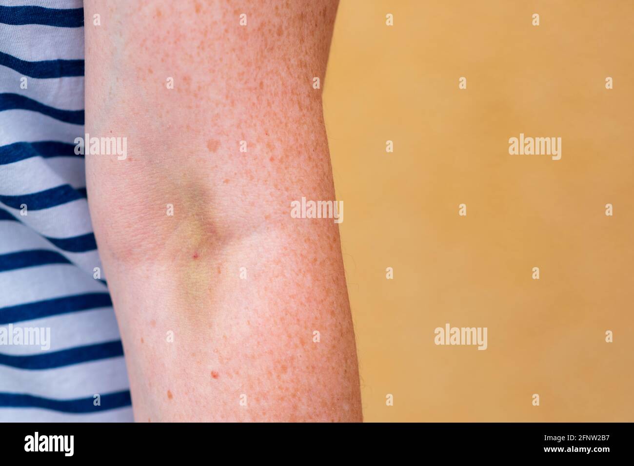 Hematoma hires stock photography and images Alamy
