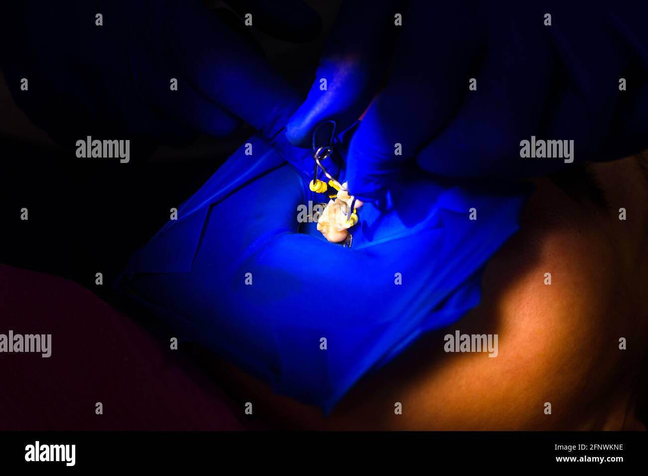 Installation of a rubber dam by a dentist, sterile and modern dental treatment. new Stock Photo