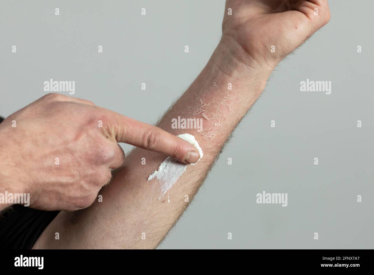 Sunscreen being applied on a sunburnt peeling skin on a damaged mans arm. A painful dry injured cracked part of the body healing from too much uv ligh Stock Photo