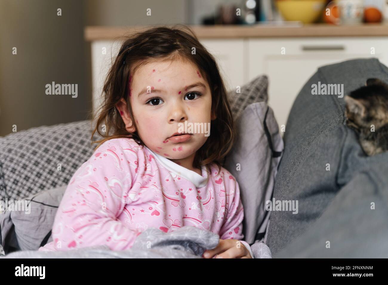 Toddler girl with chickenpox measles on the body. Varicella virus