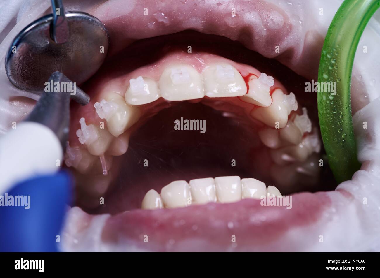 Close up of periodontist using dental tools while cleaning teeth of patient, with cheek retractor in mouth and brackets on teeth receiving dental treatment. Concept of professional dental hygiene Stock Photo