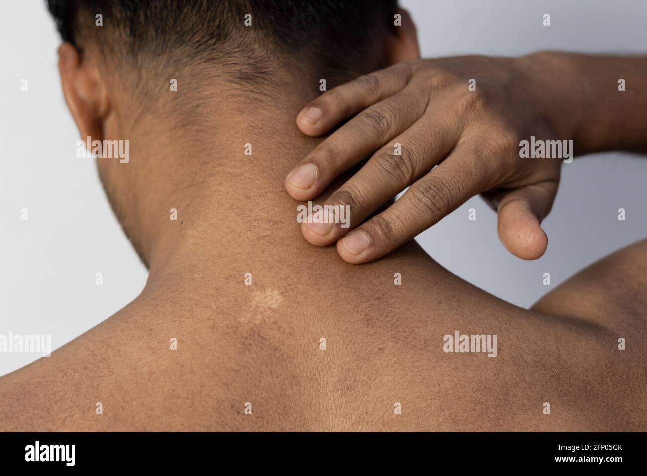 An Indian man showing white scar on his skin, healthcare concept Stock Photo