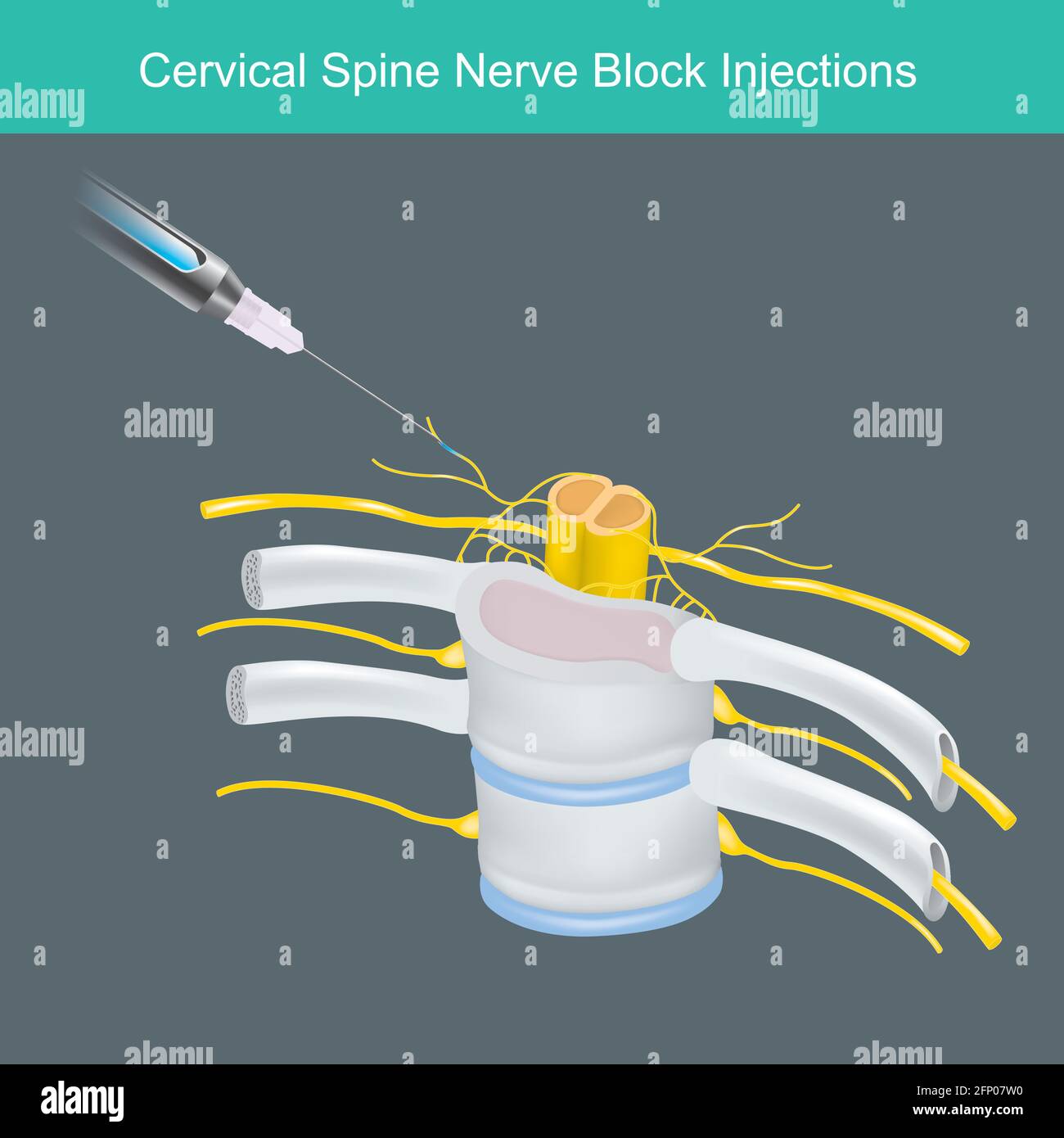Cervical Spine Nerve Block Injections. Illustration for learning Anesthetic solution injected the human neck cervical spine nerve. Stock Vector