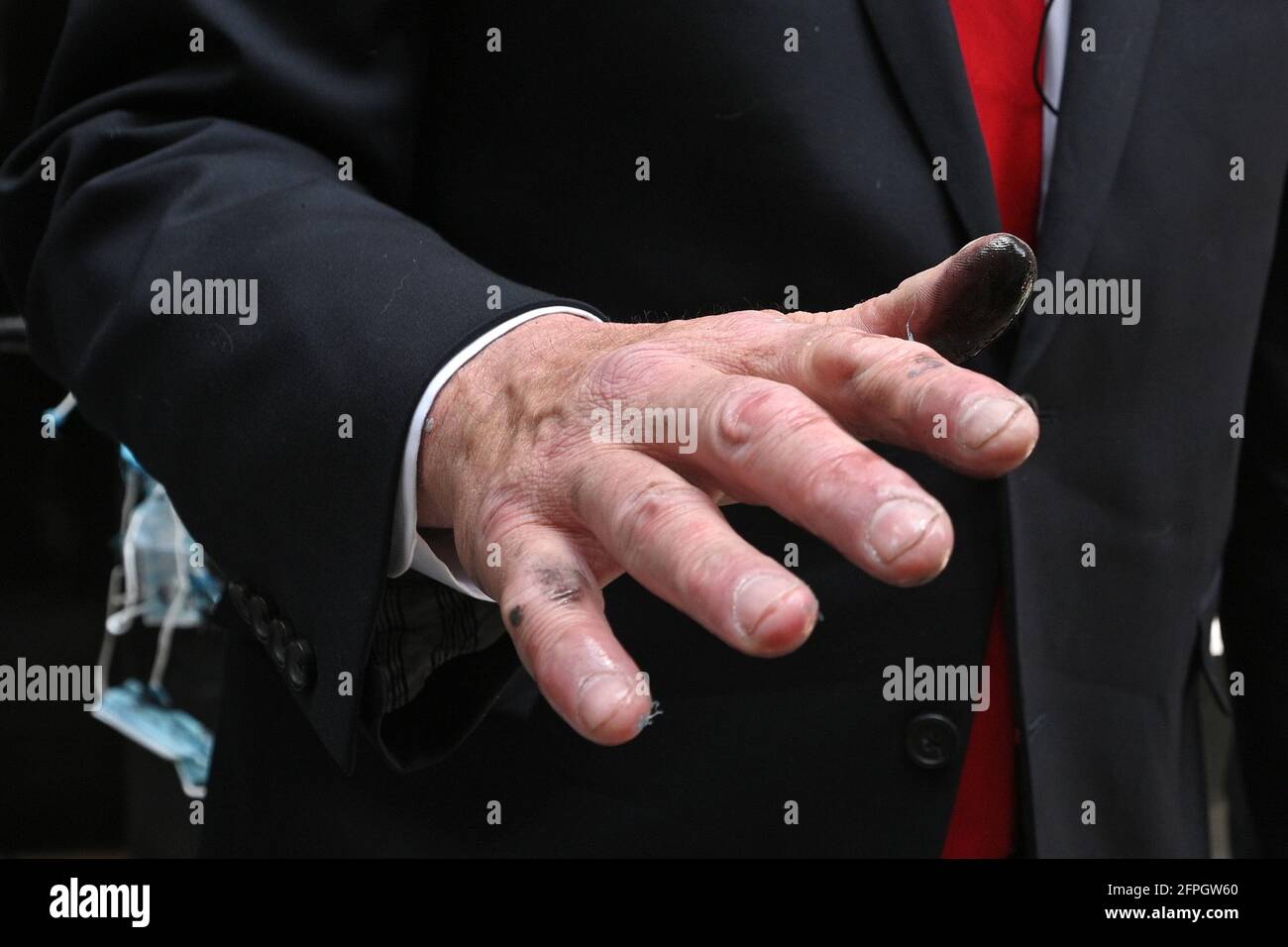 New York City Mayoral candidate Curtis Sliwa shows part of his burnt hand  after setting masks on fire in celebration of the lifting of COVID-19  pandemic mandate for New York City residents