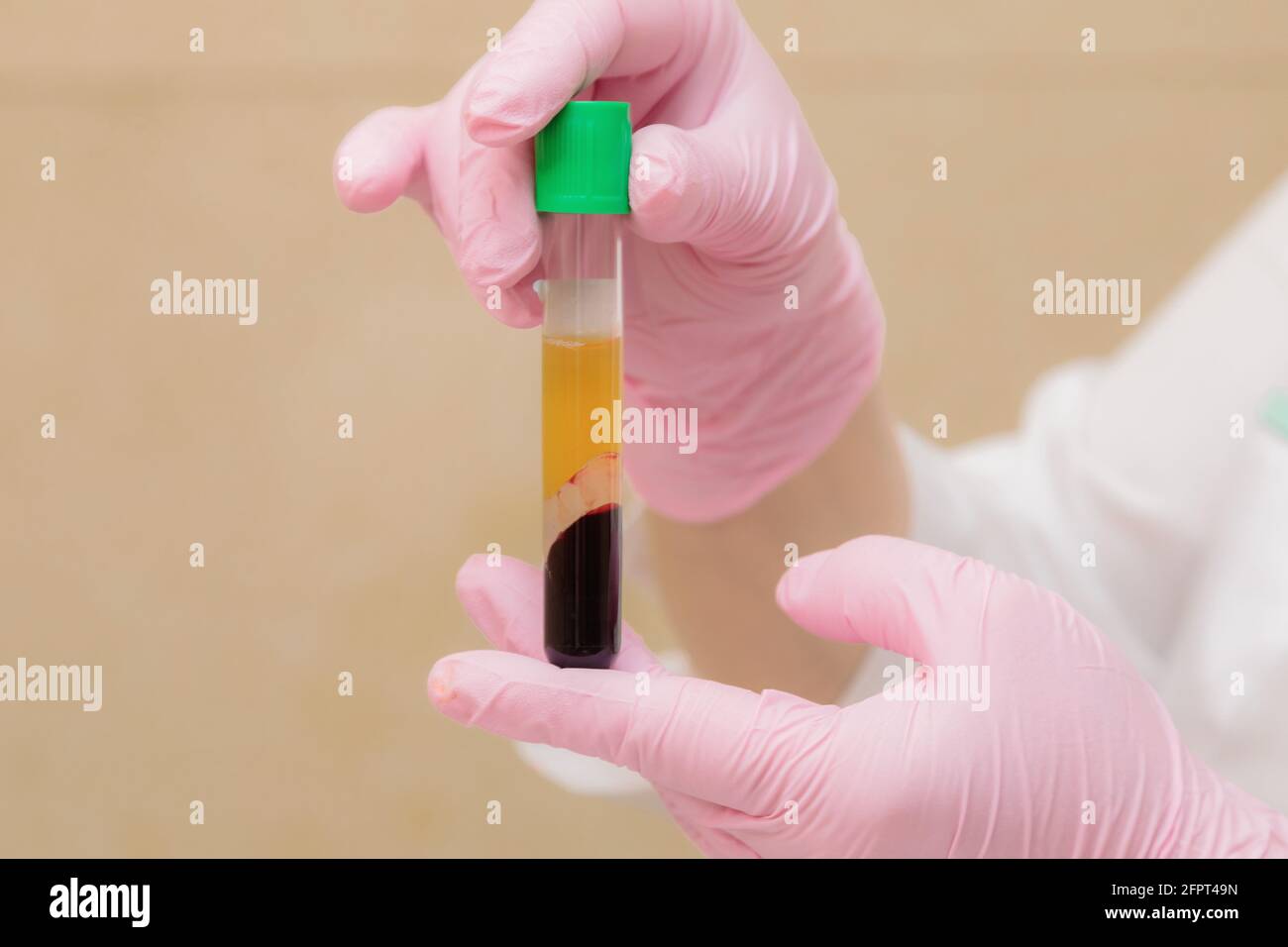 A test tube with blood plasma in the hand of a specialist. Plasmolifting, medical cosmetology. Stock Photo