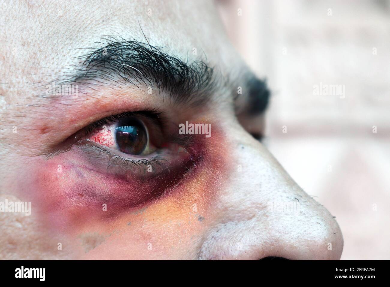 Closeup Red Blood Conjunctivitis Eyes Of Male Infected With Mucormycosis Known As Black Fungus Disease Affecting People In India Symptoms And Treatme Stock Photo Alamy