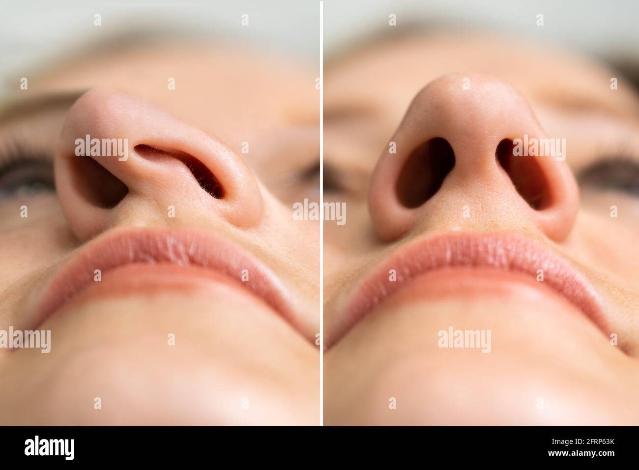 Before After Young Woman Aesthetic Facelift. Rhinoplasty Nose Surgery Stock Photo