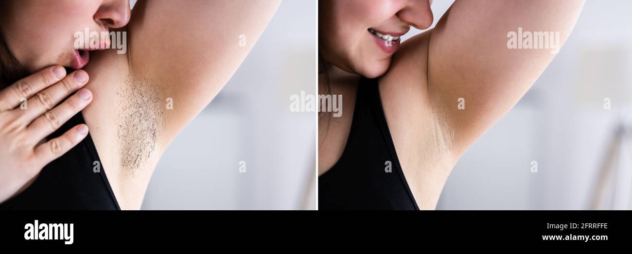 Before After Laser Hair Removal And IPL Stock Photo