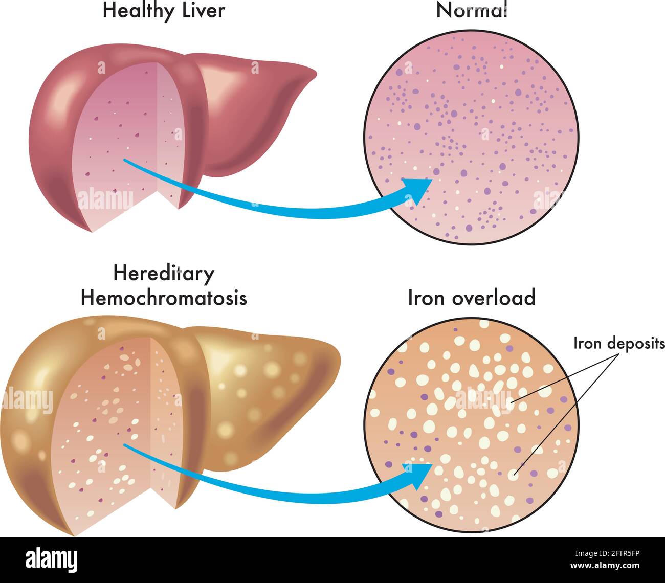 Medical illustration shows the difference between a healthy liver and one with hereditary hemochromatosis, with enlarged details and annotations. Stock Vector