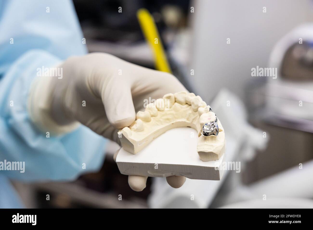 Dentist holding dental prosthesis imprint with metal crown on molar tooth Stock Photo