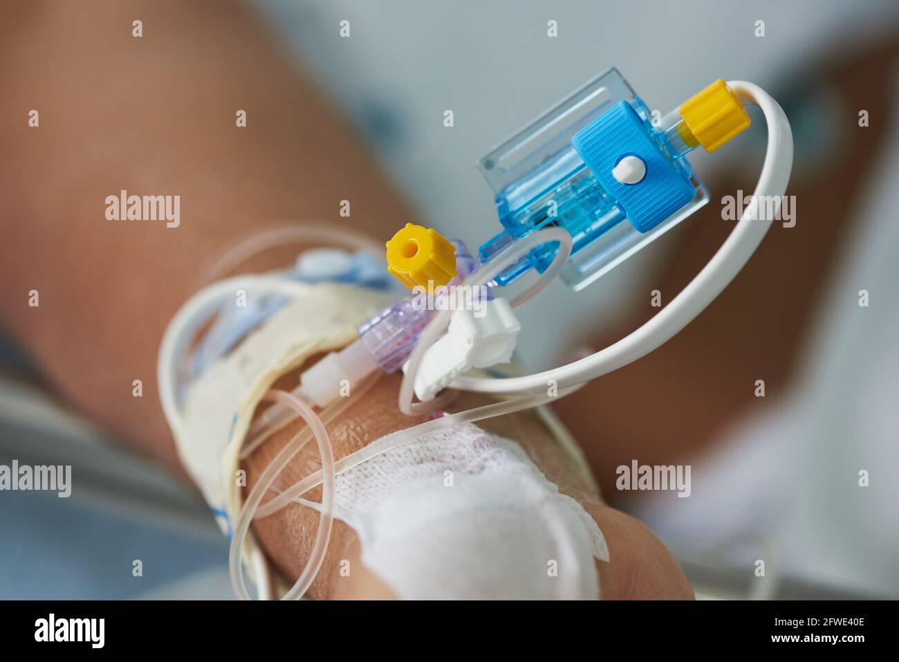 Closeup view of arterial line on the patient wrist in intensive care