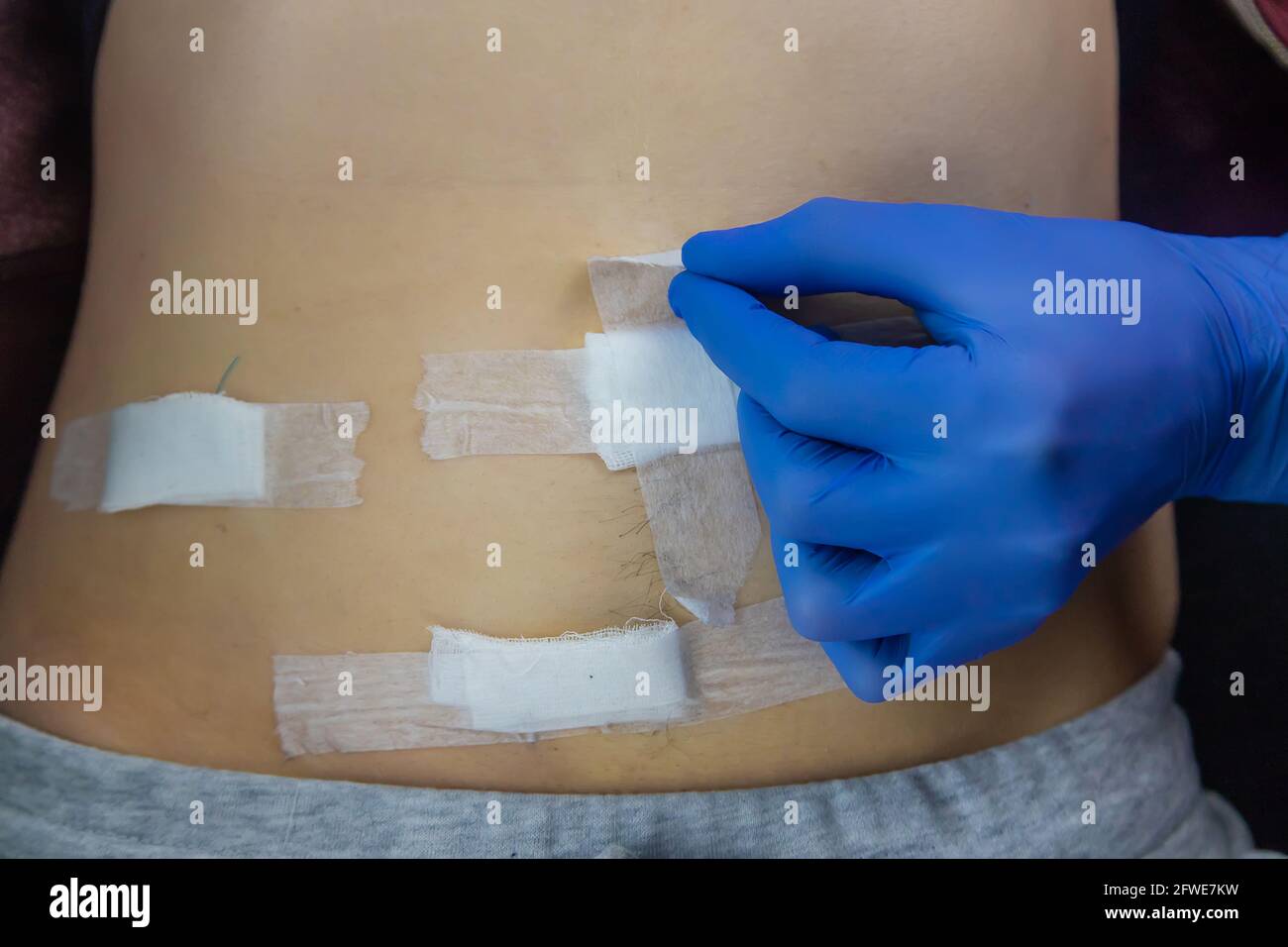 Closeup fresh appendix surgery scar hires stock photography and images Alamy