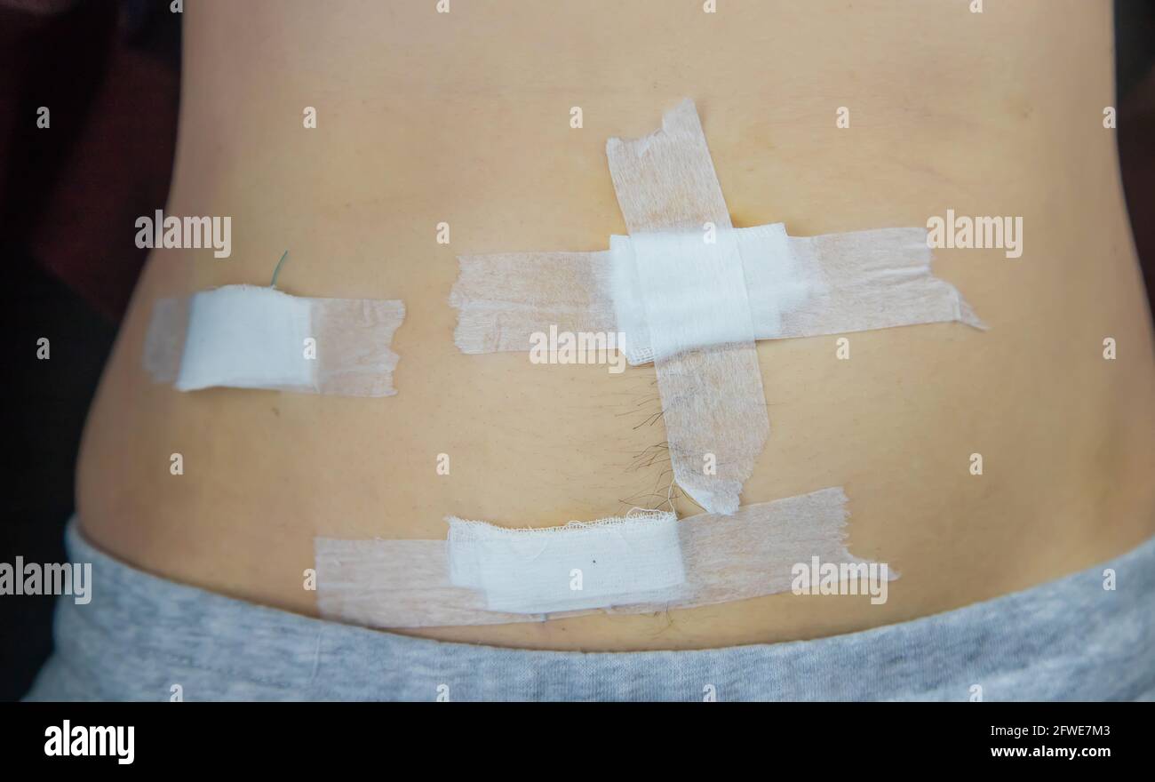Appendix scar hires stock photography and images Alamy