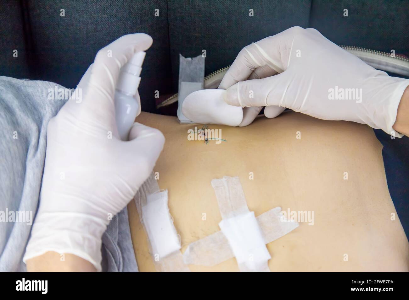 Appendix scar hires stock photography and images Alamy