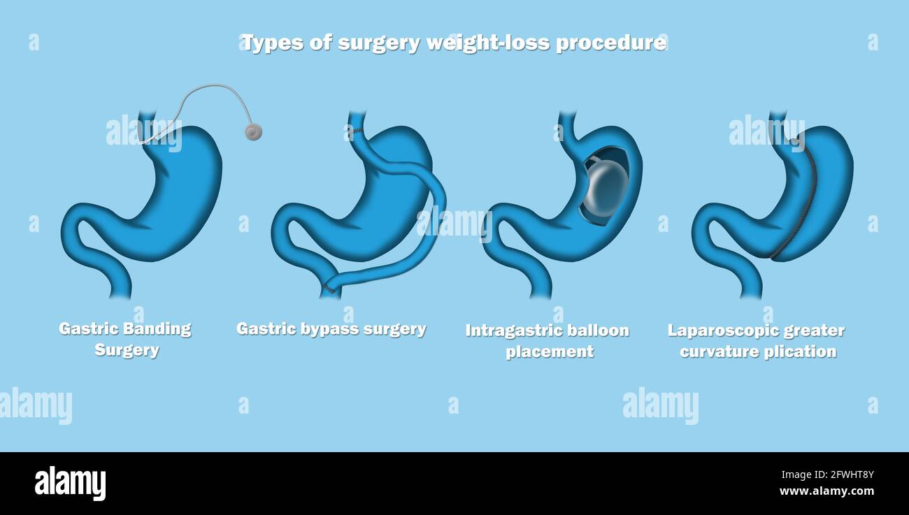 Illustration of Types of surgery weight loss procedure Stock Photo Alamy