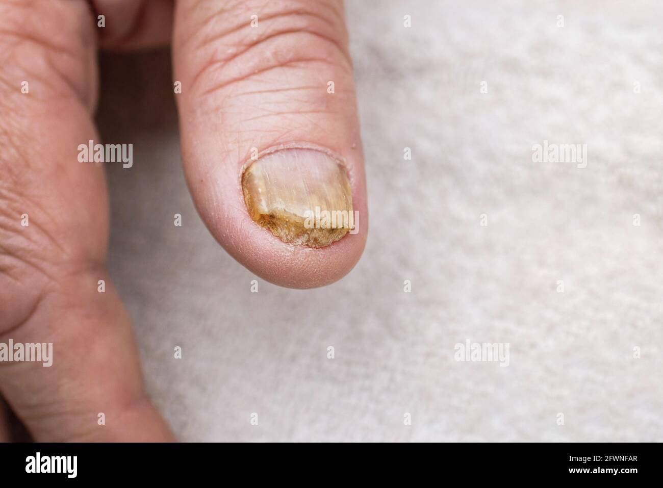 Nail fungus infection on the big finger. Fungal infection on nails hand,  finger with  up Stock Photo - Alamy