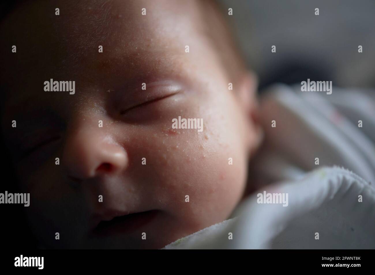 Baby with neonatal acne sleeping peacefully Stock Photo