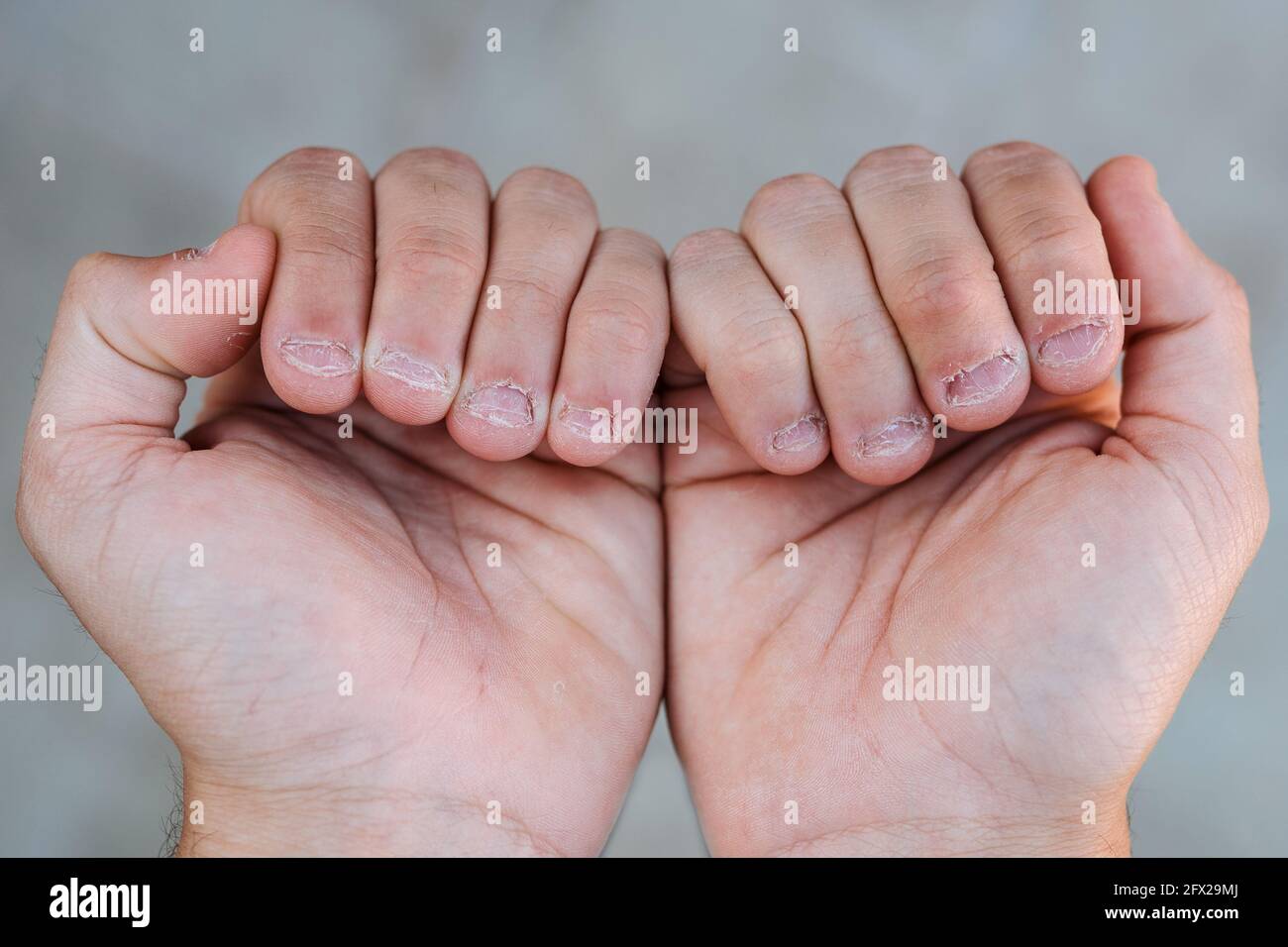 Biting nails bad habit hi-res stock photography and images - Alamy
